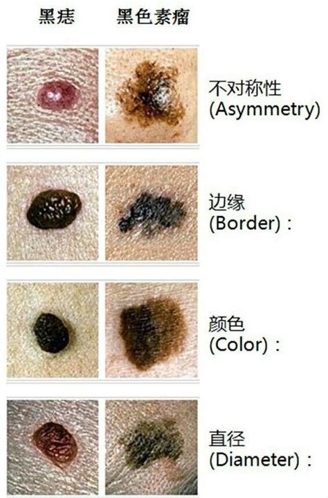 有問題的痣|痣也可能会癌变！长在 3 个地方要注意